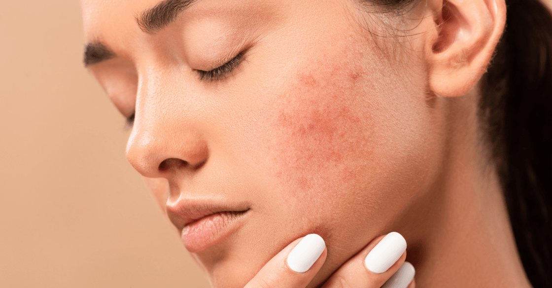 16 Effective and Safe Remedies for Acne