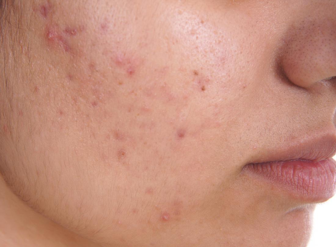 Acne Self-Care: A Complete Guide to Clearer Skin